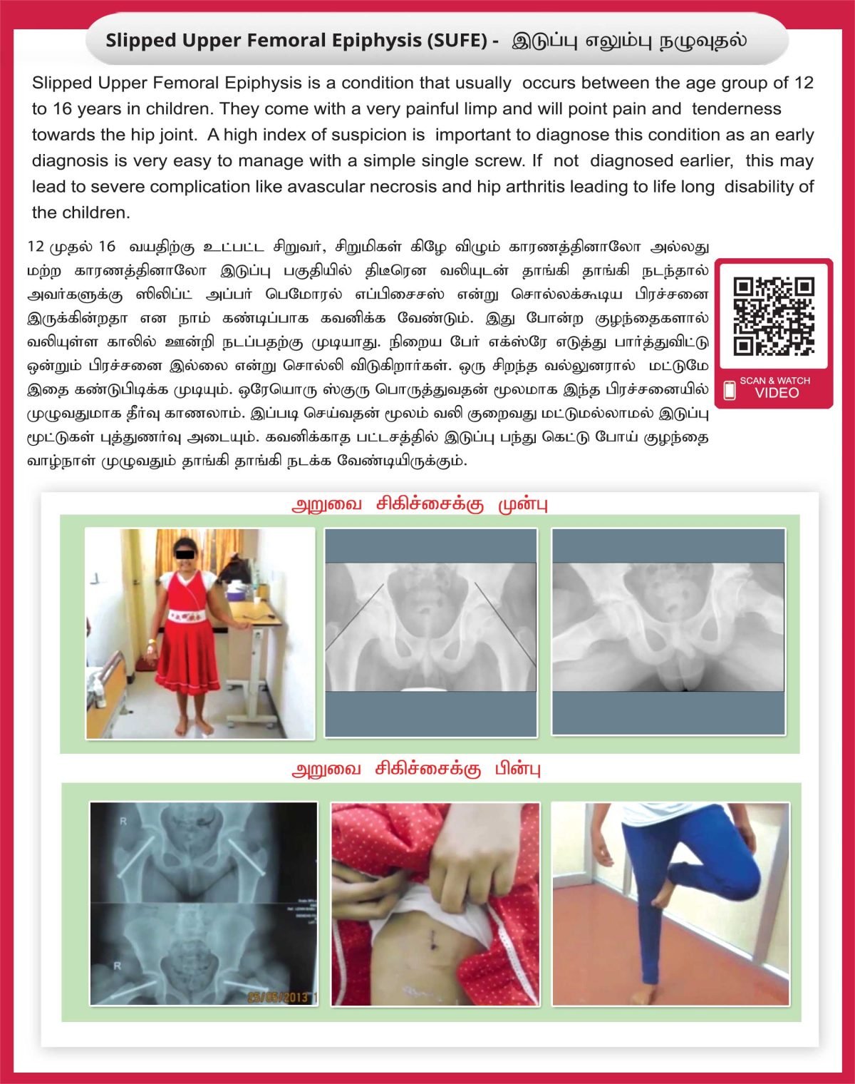 Slipped Upper Femoral Epiphysis